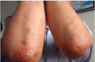 长春博润银屑病医院 长春博润银屑病医院