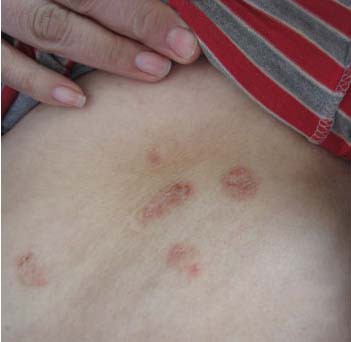 长春博润银屑病医院 长春博润银屑病医院