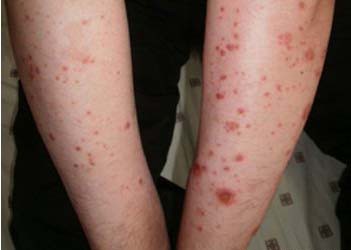 长春博润银屑病医院 长春博润银屑病医院