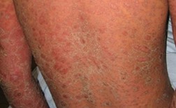 长春博润银屑病医院 长春博润银屑病医院