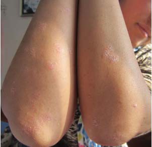 长春博润银屑病医院 长春博润银屑病医院