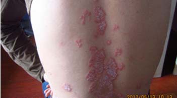 长春博润银屑病医院 长春博润银屑病医院