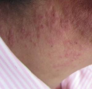 长春博润银屑病医院 长春博润银屑病医院