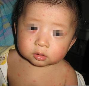 长春博润银屑病医院 长春博润银屑病医院