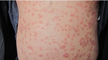 长春博润银屑病医院 长春博润银屑病医院