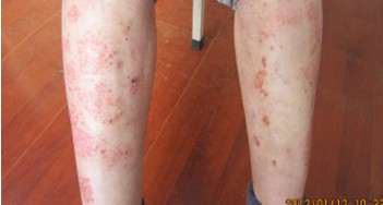 长春博润银屑病医院 长春博润银屑病医院