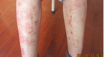 长春博润银屑病医院 长春博润银屑病医院