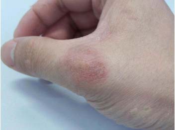 长春博润银屑病医院 长春博润银屑病医院