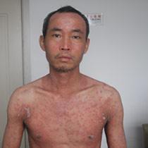 长春博润银屑病医院 长春博润银屑病医院