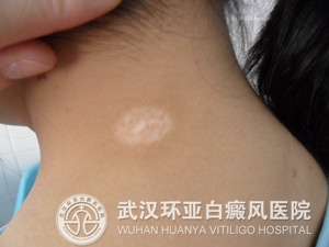 诊断白癜风要注意哪些事项