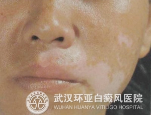 青少年白癜风怎么治好