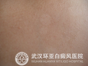 白癜风产生的原因有哪些