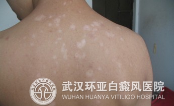 日常护理白癜风要注意哪些事项