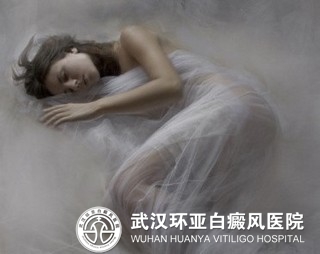 女性患上白癜风有哪些原因