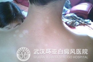是什么原因导致白癜风发病的