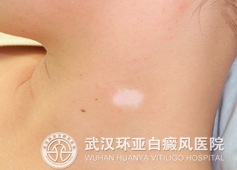 日常护理白癜风有哪些事项要注意