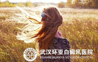 治疗女性白癜风有哪些方法