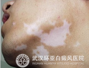 青少年白癜风治疗的注意事项