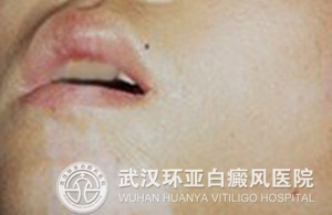 男性白癜风治疗注意哪些
