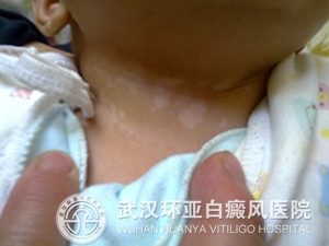 儿童治疗白癜风要注意哪些事项