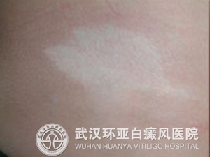 日常治疗白癜风疾病该注意哪些