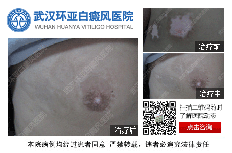 武汉哪家医院的白癜风较好
