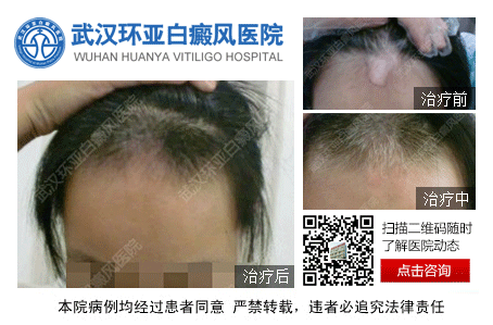 武汉到哪家医院治疗白癜风较好