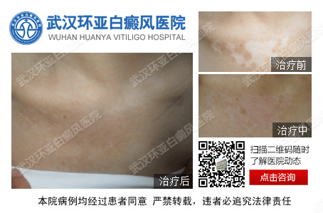 武汉哪家医院治白癜风治得好