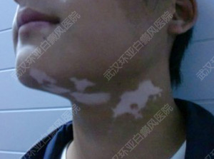 少年与青少年过渡时,面部颈部出现明显白斑