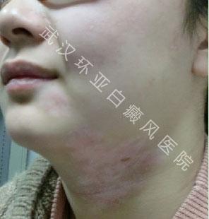 早期白斑  拒绝即将到来的蔑视!