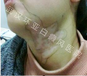 早期白斑  拒绝即将到来的蔑视!