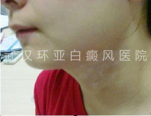 早期白斑  拒绝即将到来的蔑视!