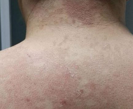 武汉白癜风医院解答?如何判断散发型白癜风?