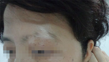 武汉较好的白癜风医院?为什么应激反应会引起白癜风?