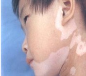 武汉白癜风医院排名?不同阶段的白癜风有哪些症状?