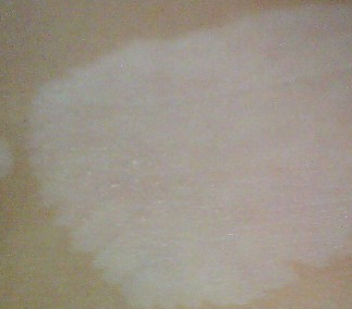 武汉哪家医院治白斑好?武汉白癜风患者吃牛油果吗有什么影响吗?