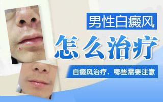 男性脸部出现白癜风要如何治疗呢